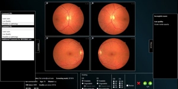 UC e Retmarker vão criar tecnologia para o rastreio ocular a diabéticos
